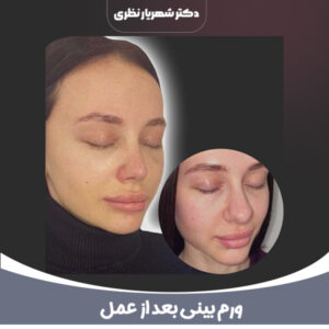 عکس ورم بینی بعد از عمل