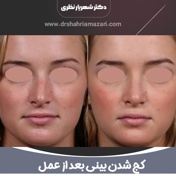 کج شدن بینی بعد از عمل