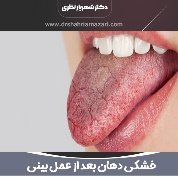 خشکی دهان بعد از عمل بینی